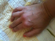 Rheumatoid Arthritis Image