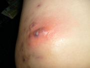 hidradenitis suppurativa support and wellness Image
