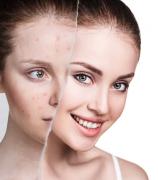 How Isotroin 20mg Capsules Can Help Clear Your Acne Image